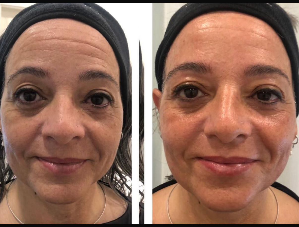 Tratamiento facial 2