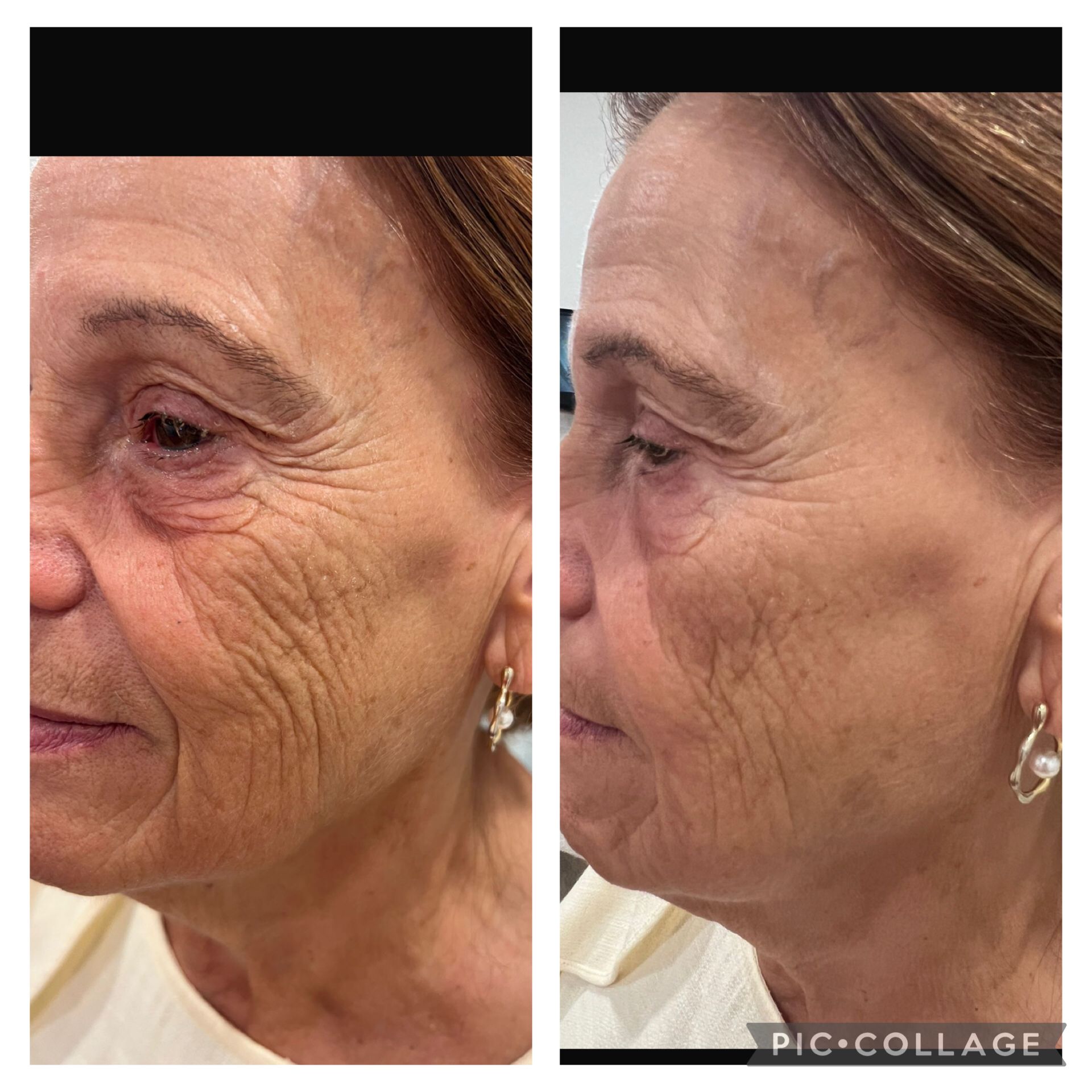 Antes y después OnFace